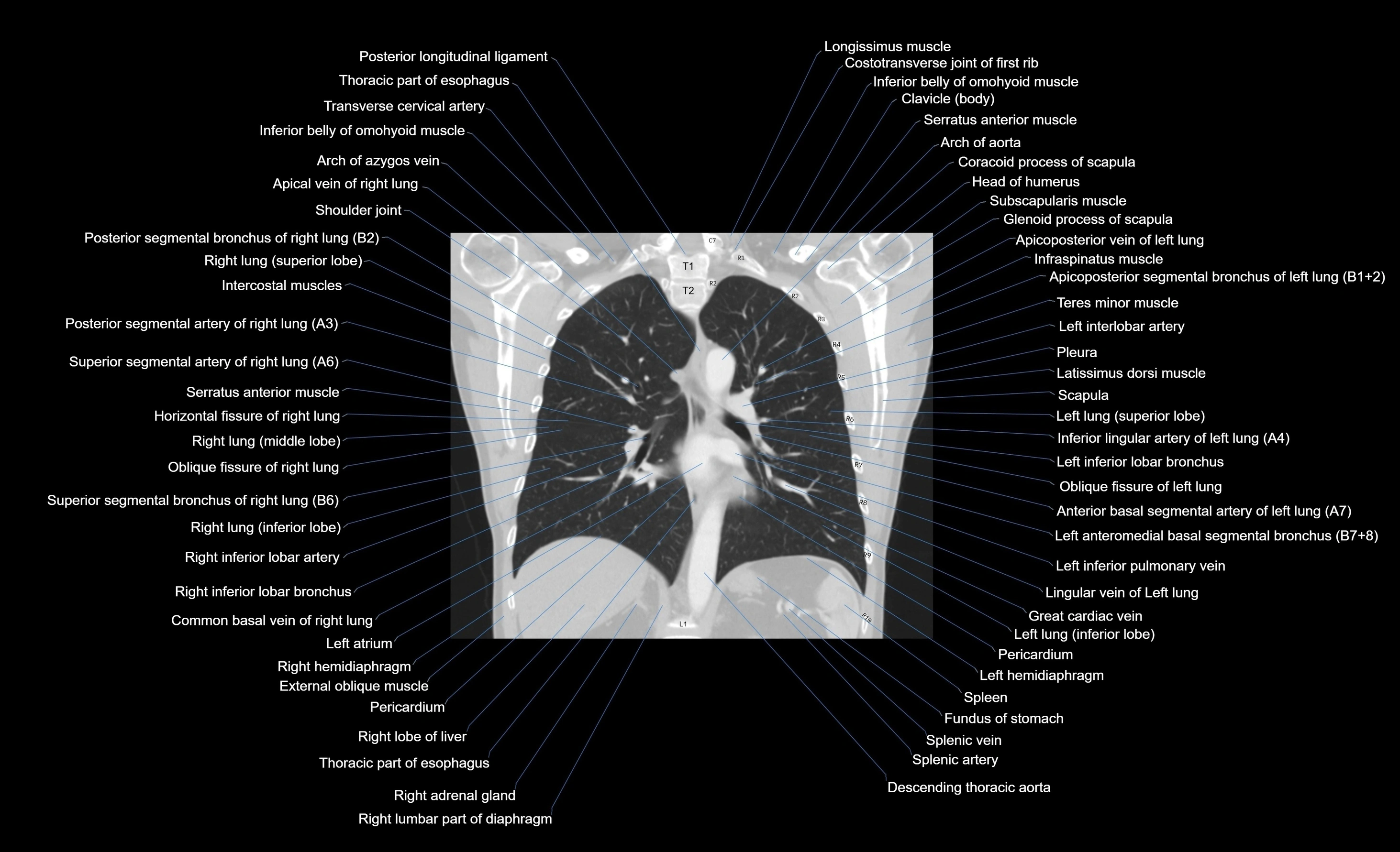 CT chest (thorax) lung window window labelled coronal cross sectional anatomy radiology image-00052.webp